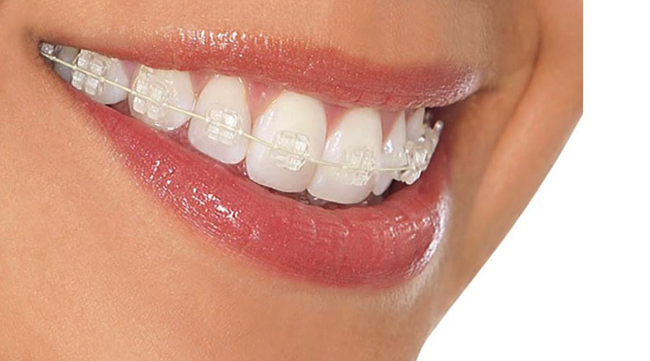 Aparat dentar fix Safir